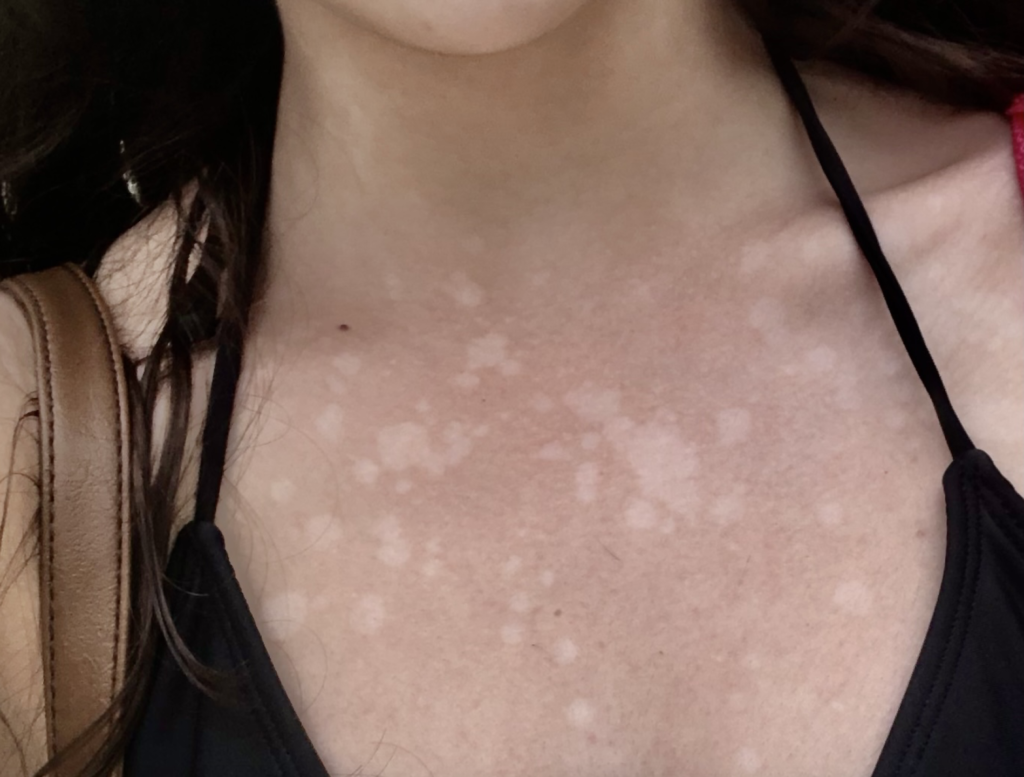 My At Home Tinea Versicolor Cure Fast Results Radiantly Nourished