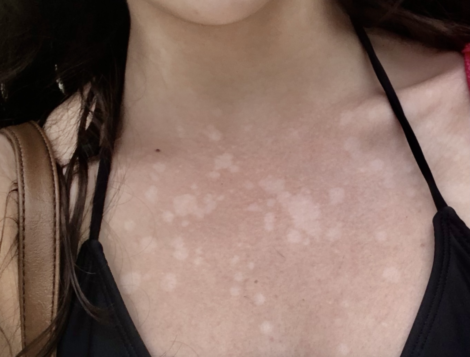 My At Home Tinea Versicolor Cure Fast Results Radiantly Nourished 