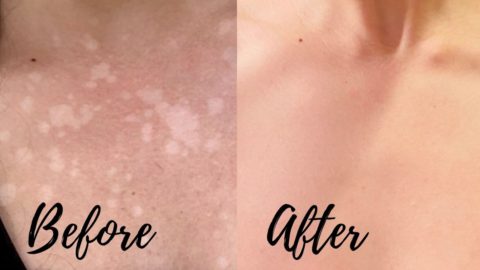 Tinea Versicolor Cure